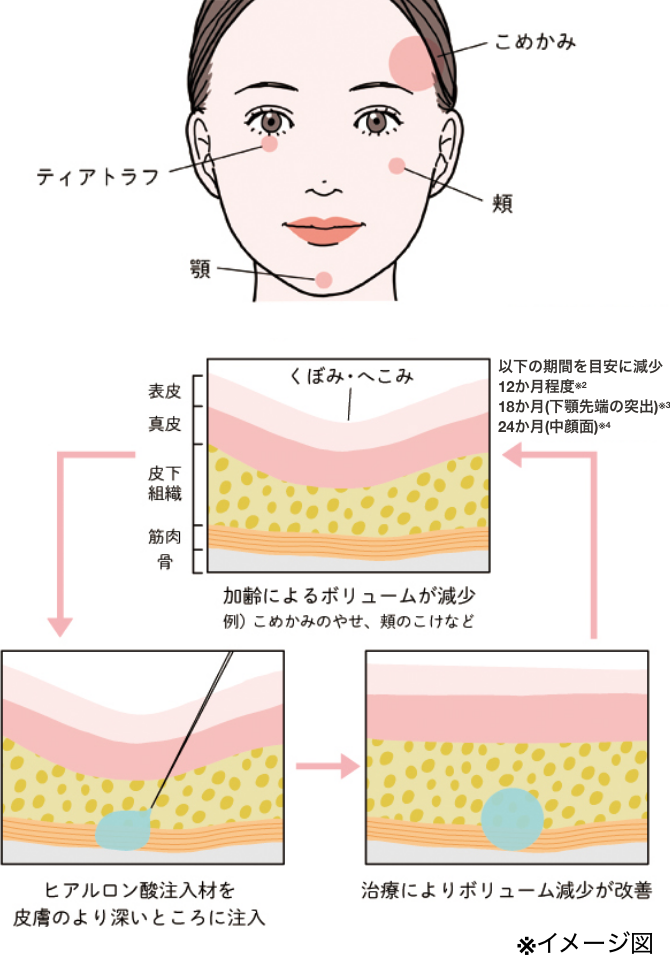 減少した顔のボリューム回復の図