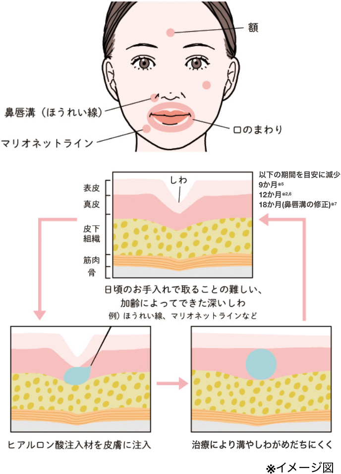 しわ・溝の改善治療（一例）の図