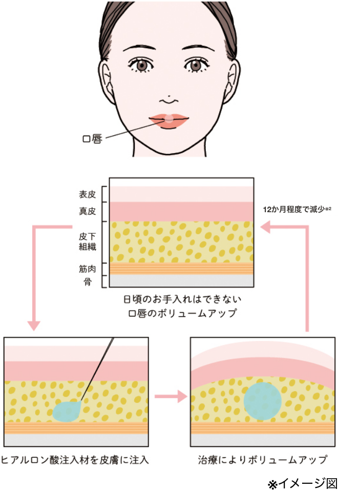 口唇のボリュームアップの図